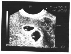 7 недель двойня беременности