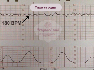 Тахикардия у плода на 35 неделе беременности