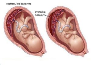 Отслойка плаценты на 12 неделе беременности