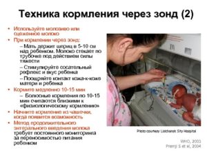 Кормление через зонд ребенка алгоритм