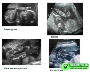 Узи на 32 недели беременности пол ребенка
