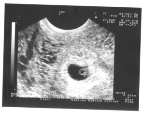 Сердцебиение на 6 неделе беременности узи