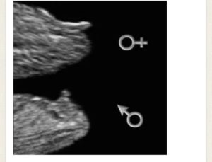 Можно ли узнать пол на 13 неделе беременности