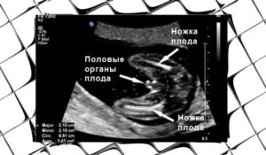 17 недель беременности пол ребенка узи