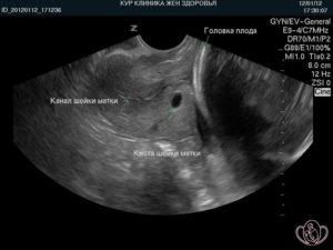 Шейка матки на 12 неделе беременности