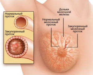 Уплотнение в молочной железе у кормящей мамы