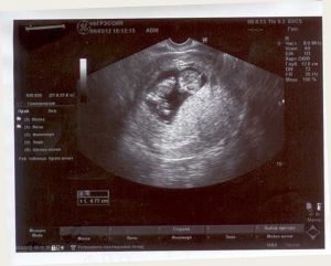 Гипертонус матки при беременности 12 недель