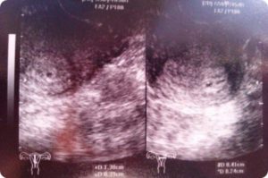Беременность 2 недели от зачатия симптомы