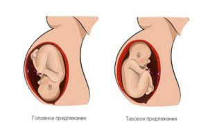 Тазовое предлежание плода на 34 неделе беременности