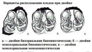 Двойня дихориальная диамниотическая 31 неделя беременности