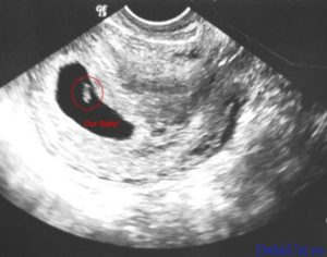 6 недель беременности не видно на узи эмбриона