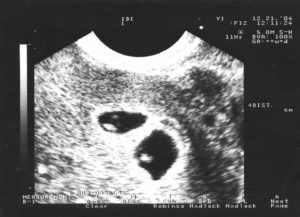 6 недель беременности узи двойня