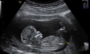 Скрининг на 14 неделе беременности