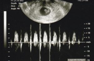 Сердцебиение на 8 неделе беременности