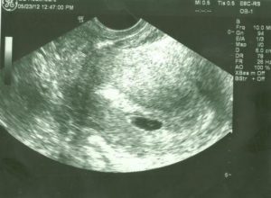 4 эмбриональная неделя беременности узи