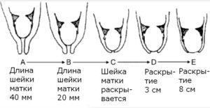 Короткая шейка матки при беременности 35 недель