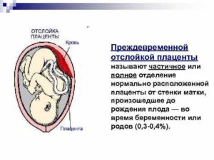 Отслойка плаценты на 13 неделе беременности