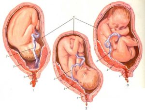 Низкое расположение плаценты при беременности 12 недель