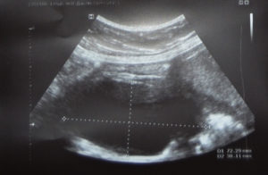 Киста на плаценте при беременности 33 недели
