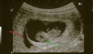 На 6 неделе беременности отслойка