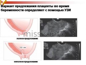 Центральное предлежание хориона на 13 неделе беременности