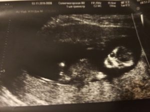 11 недель беременности пол ребенка