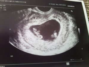 6 недель беременности узи двойня