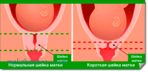 Шейка матки короткая при беременности 24 недели