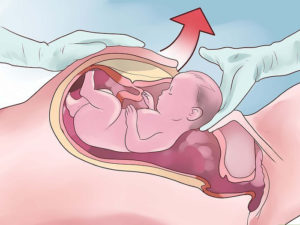 Кесарево сечение на 40 неделе беременности