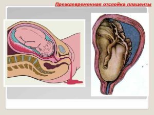 Отслойка плаценты на 12 неделе беременности