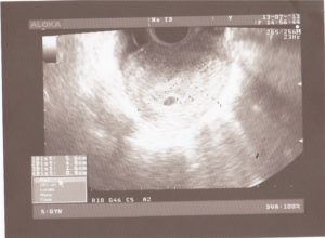5 недель 3 дня беременности акушерских