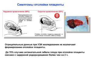 Отслойка плаценты на 40 неделе беременности симптомы