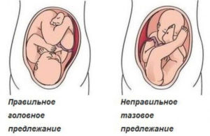 Головное предлежание плода при беременности на 20 неделе