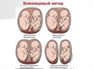 Двойня дихориальная диамниотическая 31 неделя беременности