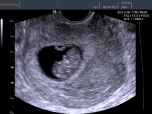 8 недель беременности акушерский срок