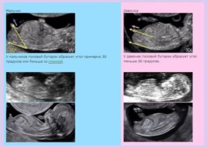 Можно ли на 11 неделе беременности узнать пол ребенка