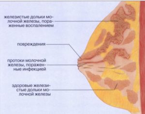 К какому врачу обращаться при мастите у кормящих мам