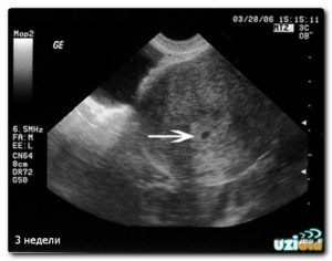 Узи на 3 неделе беременности от зачатия
