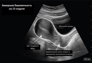 Признаки замершей беременности на 7 неделе