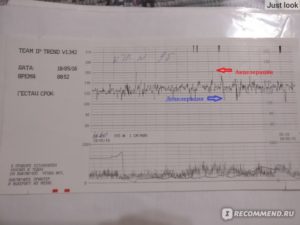 Ктг на 40 неделе беременности