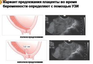 Предлежание плаценты при беременности 12 недель