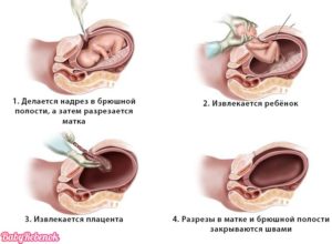 38 неделя беременности кесарево сечение плановое второе