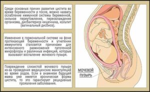 Цистит при беременности 2 триместр