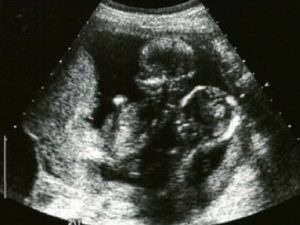 16 неделя беременности двойней