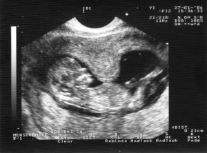 Гипертонус матки при беременности 12 недель