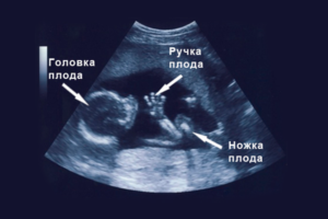 17 недель беременности пол ребенка узи