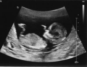 На 12 неделе беременности рвота