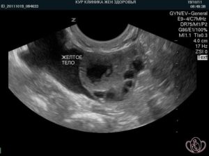 После овуляции желтое тело маленькое