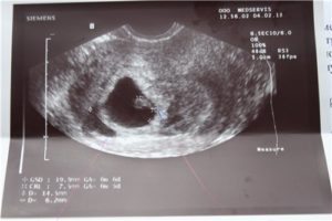 На 6 неделе беременности отслойка
