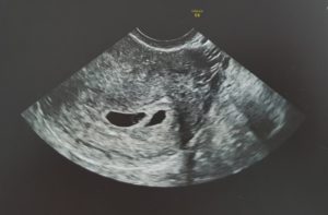 4 недели беременности не видно эмбриона